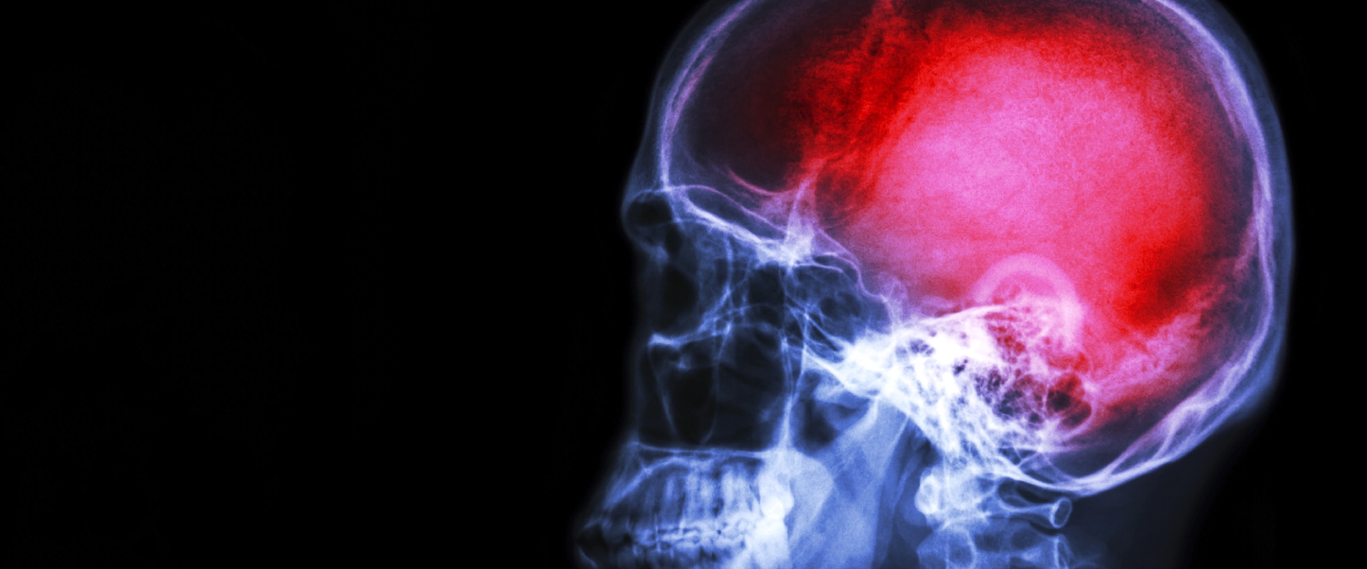 Can pain change the brain?